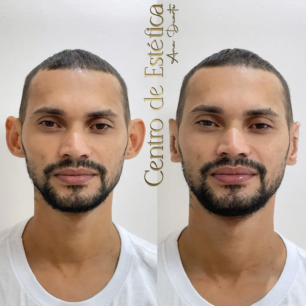 Resultado de Otomodelação no Centro Estético Ana Duarte: antes e depois da correção de orelhas de abano sem cirurgia — paciente 1