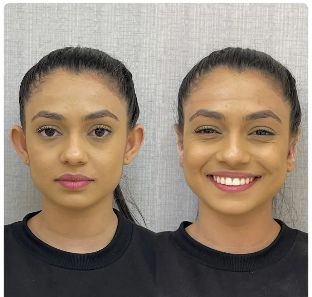 Resultado de Otomodelação no Centro Estético Ana Duarte: antes e depois da correção de orelhas de abano sem cirurgia — paciente 2