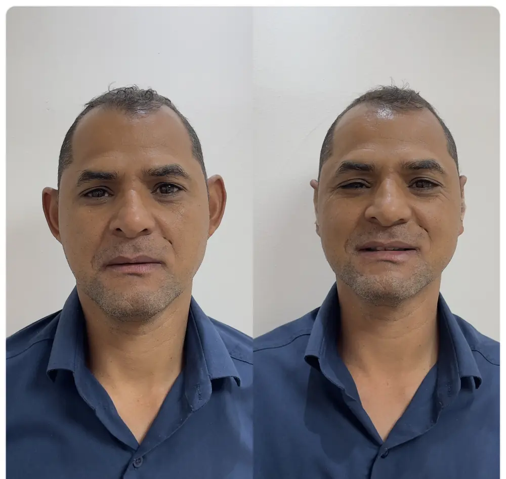 Resultado de Otomodelação no Centro Estético Ana Duarte: antes e depois da correção de orelhas de abano sem cirurgia — paciente 5