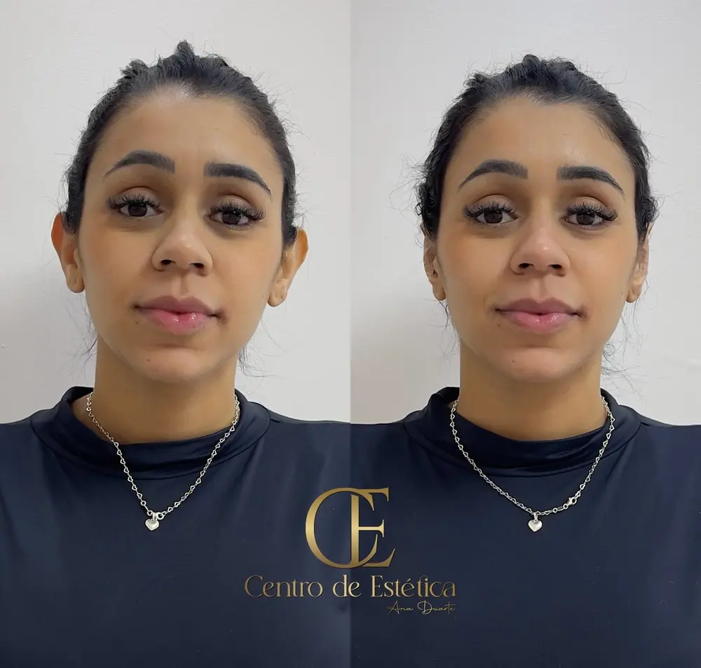 Resultado de Otomodelação no Centro Estético Ana Duarte: antes e depois da correção de orelhas de abano sem cirurgia — paciente 6