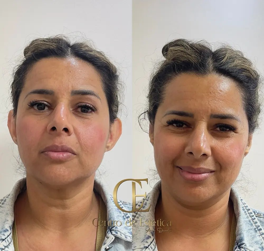 Resultado de Otomodelação no Centro Estético Ana Duarte: antes e depois da correção de orelhas de abano sem cirurgia — paciente 7