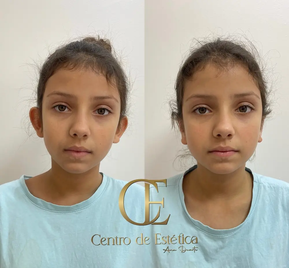 Resultado de Otomodelação no Centro Estético Ana Duarte: antes e depois da correção de orelhas de abano sem cirurgia — paciente 8